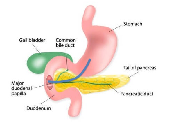 EUS-guided biliary and pancreatic duct drainage